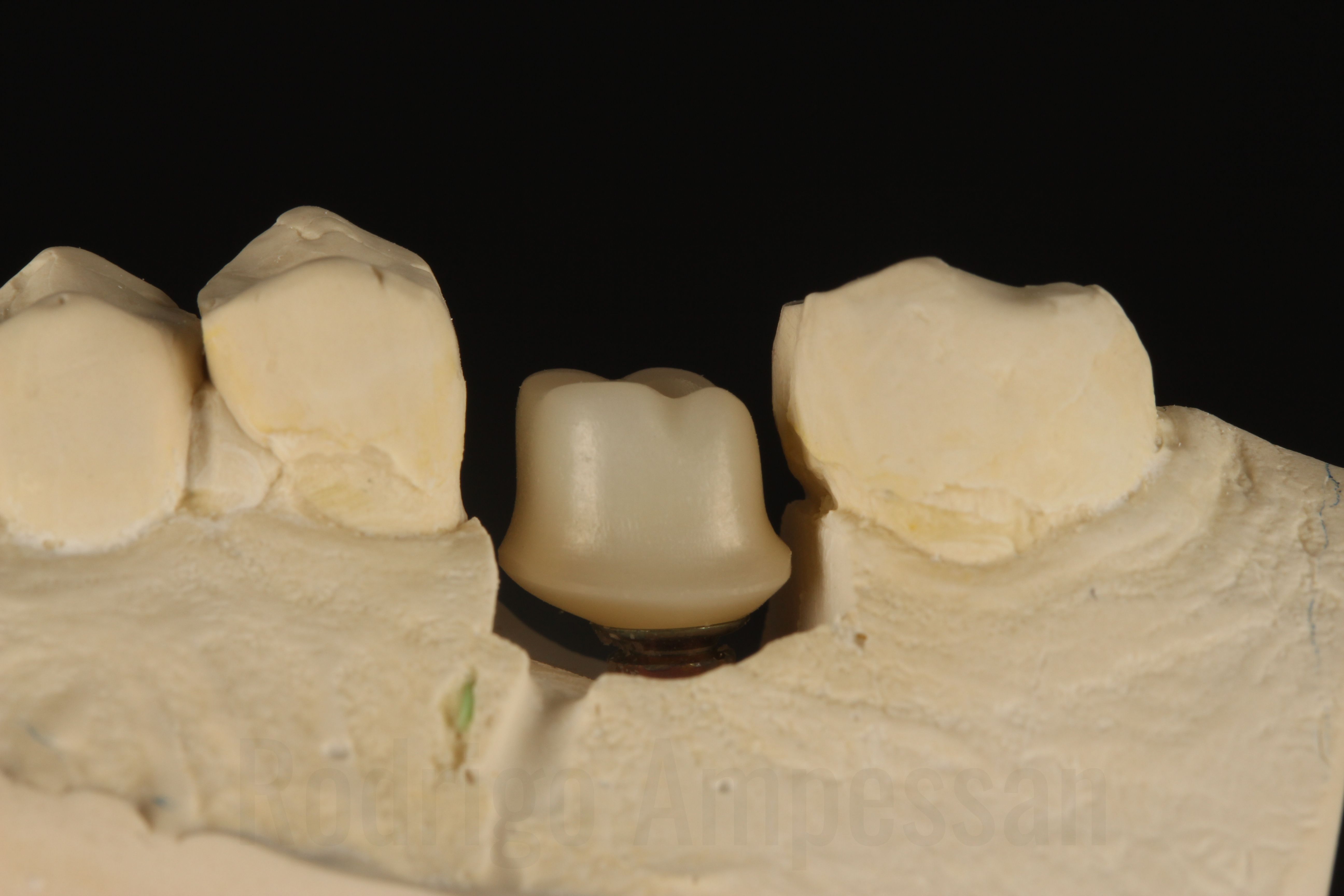 Abutment personalizado