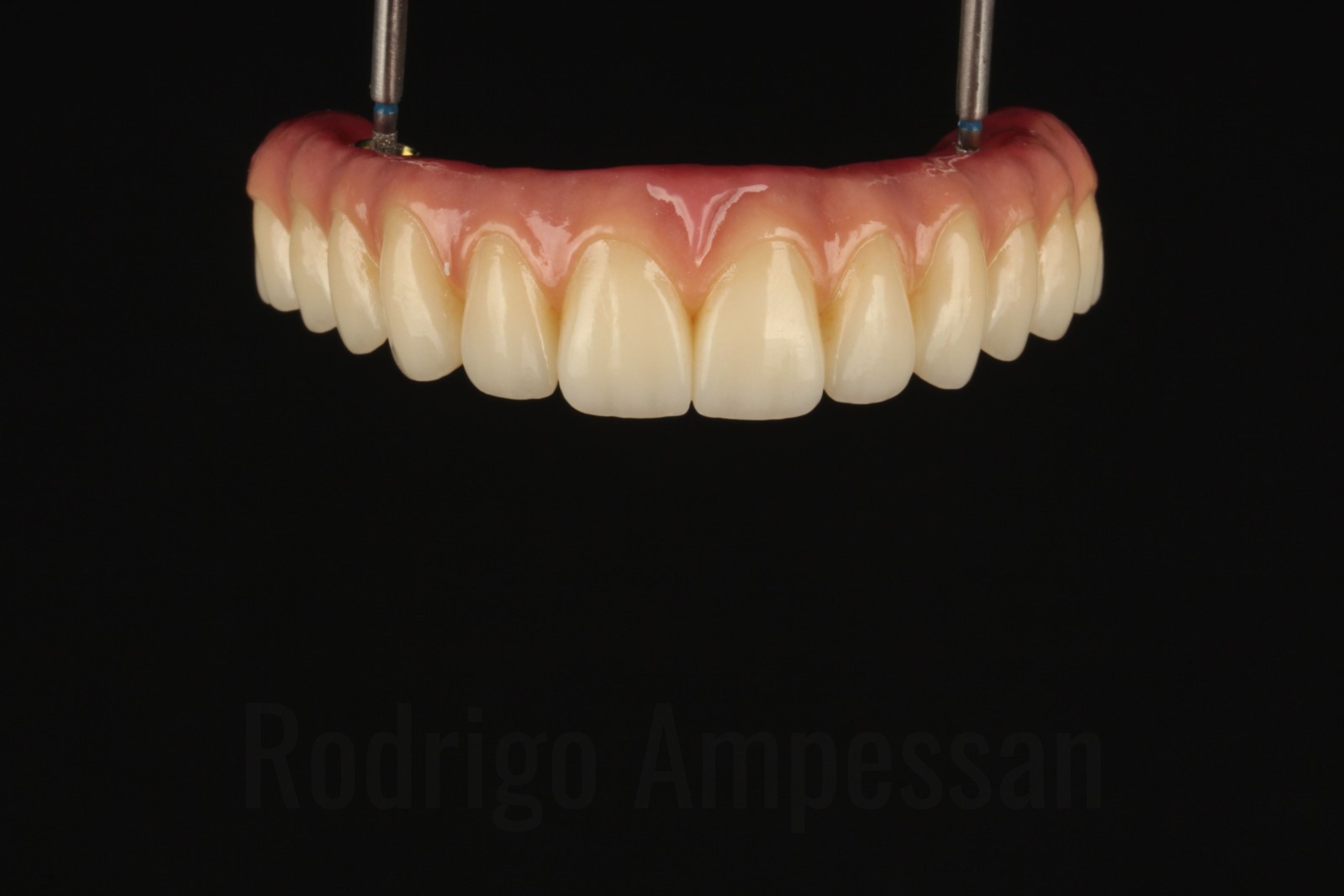 Protocolo de zircônia com gengiva estratificada