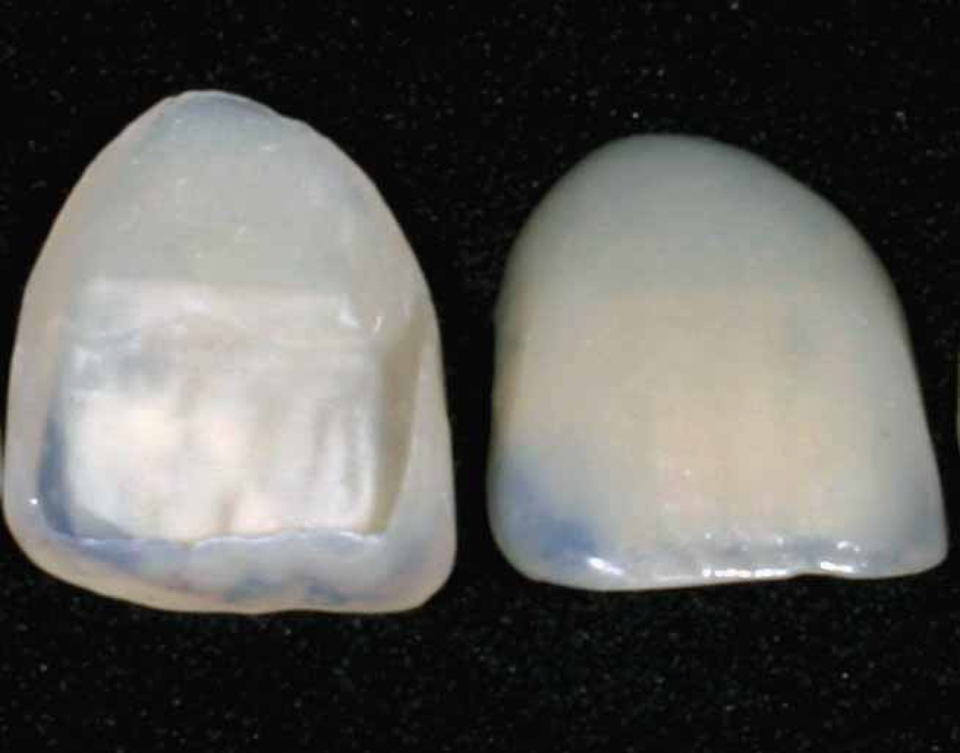 Facetas laminadas